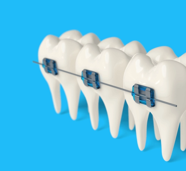 自鎖式矯正器就是戴蒙矯正器?4大矯正器費用、優缺一篇就懂!