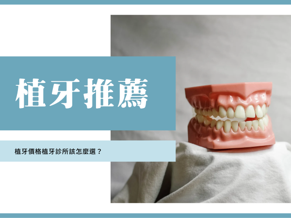 植牙價格 植牙推薦 植牙價錢