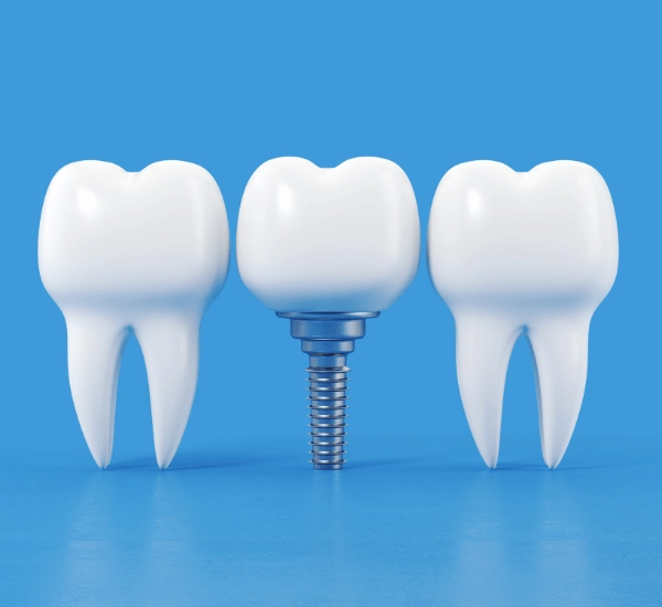 台北植牙推薦醫師一覽！台北植牙費用、案例醫師全解析