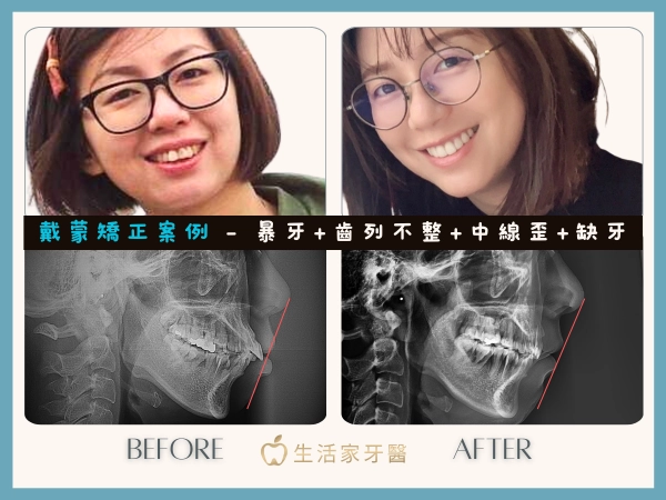 戴蒙矯正案例-暴牙 中線歪 缺牙 齒列不整