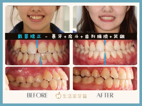 戴蒙矯正案例 暴牙 戽斗 中線歪 齒列凌亂 虎牙擁擠 笑齦