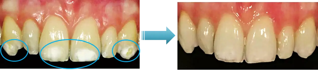牙齒脫鈣 牙齒白斑 滲透型樹脂