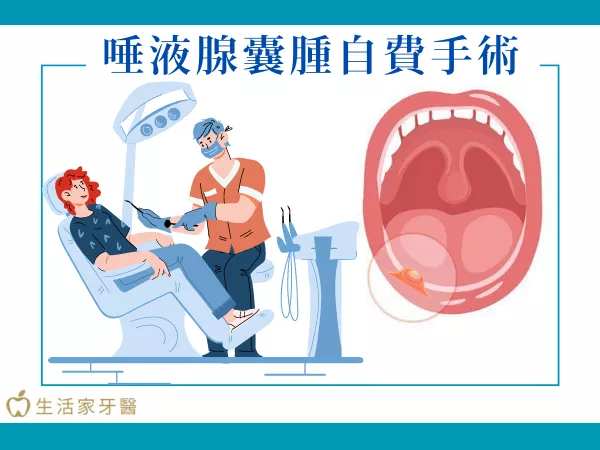 唾液腺囊腫開刀　唾液腺囊腫手術